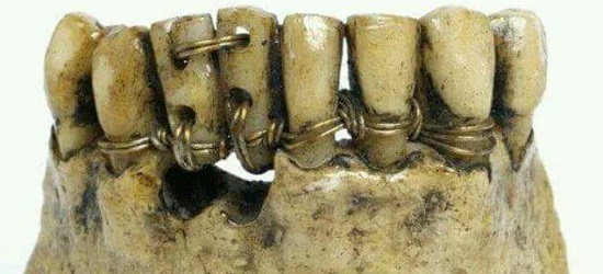 история имплантации зубов