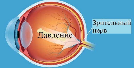 Глаукома глаза что это такое 