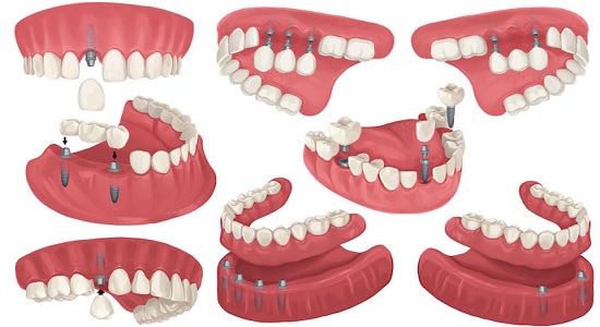 способы протезирования зубов