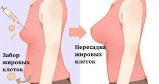 Липофилинг груди
