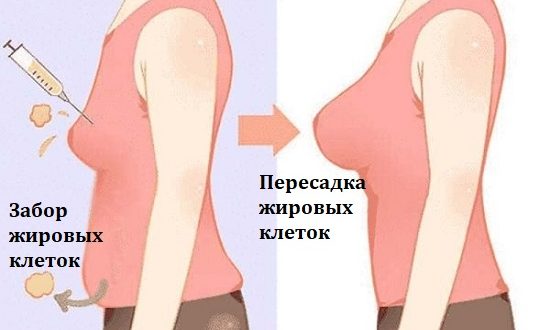 Липофилинг груди