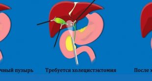 холецистэктомия