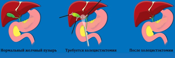 холецистэктомия
