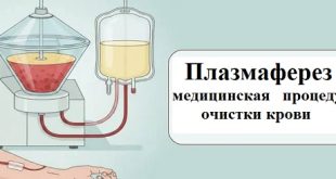 плазмаферез