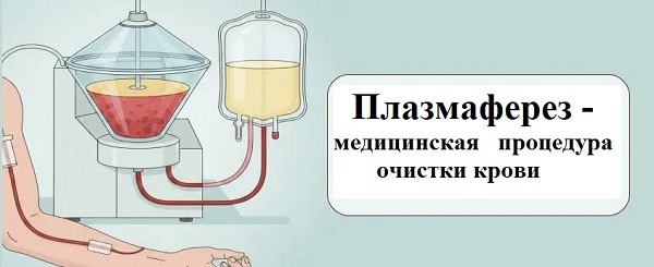 плазмаферез